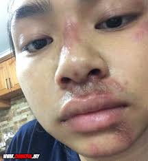 Bahaya semut charlie yang jarang diketahui karena semut ini tidak mudah untuk ditemukan. Serangga Ini Buat Pelajar Wanita Ini Hidup Dalam Trauma Oh Media