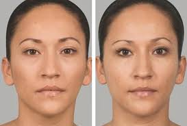 It’s recommended to correct shallow to deep nasolabial folds and wrinkles. Sculptra Thousand Oaks Best Sculptra Injections In Calabasas