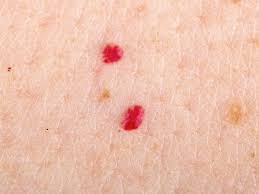 A cherry angioma (also commonly called cherry hemangiomas, campbell de morgan spots, or senile angioma) is a bright red or purple spot made up of blood vessels. What Are Red Moles And Are They Dangerous First For Women