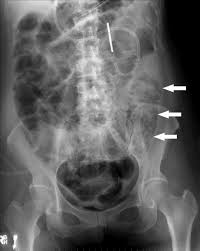 Image result for Intestinal Obstruction