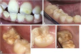 Looking for online definition of mih or what mih stands for? Prevalence Of Molar Incisor Hypomineralization And Other Enamel Defects And Associated Sociodemographic Determinants In Indiana The Journal Of The American Dental Association