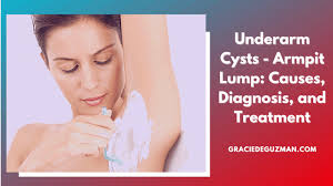 I have a lump around my armpit. Underarm Cysts Armpit Lump Causes Diagnosis And Treatment