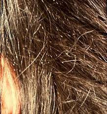 Hair dye doesn't contain any medicinal or insecticidal properties. Treatment Of Human Lice Wikipedia
