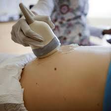 Subchorionic Hemorrhage In Pregnancy