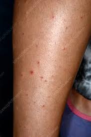 Image result for Pustular Psoriasis