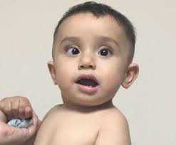 Duane retraction syndrome in a patient with abnormal head position