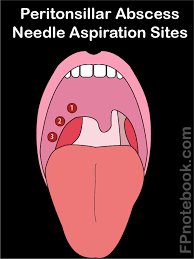 Image result for Peritonsillar Abscess