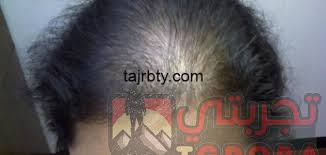 تجربتي مع الشبكية الفرنسية تجربتي