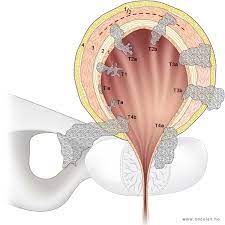 I noen familier er det større risiko for å få den godartede forstørrelsen av prostata er ikke kreft, men den kan klemme på urinrøret og gi. Stadier Og Spredningsmonster Ved Kreft I Urinblaeren