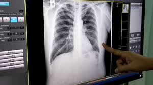 The main symptoms include shortness of breath and cough with mucus production. Symptoms And Diagnosis Of Copd Everyday Health