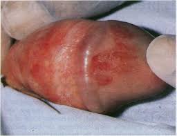 Image result for balanoposthitis
