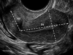 A test in which sound wave are used to examine internal structures. Normal Ultrasound Female Pelvic Anatomy Springerlink