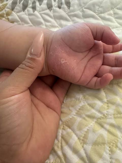 My toddler woke up with these tiny red bumps clustered all around his  ankles The nurse line is completely busy and he keeps scratching them What  is this