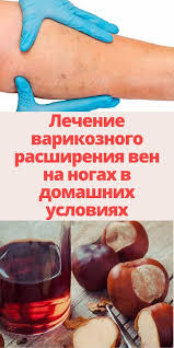 как лечить варикоз на ногах у женщин в домашних условиях Sovety V 2020 G Varikoz Zdorove Fakty O Zdorove