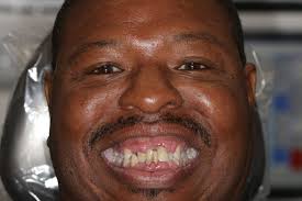 Advantages of ArchONE's Full Arch Implant System