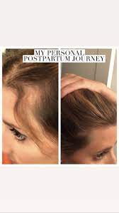 Hair Loss Monat Fixes Hair Loss After Having A Baby Monat 6 Month Results Intense Repair This Shampoo Ca Postpartum Hair Loss Hair Loss Shampoo Hair Repair