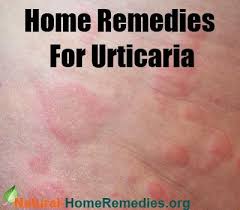 Urticaria Home Remedies Natural Remedies For Hives Hives Remedies Home Remedies