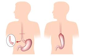 Using suspend functions and calling them with. Oesophago Gastric Cancer Surgery Total Upper Gi Surgery