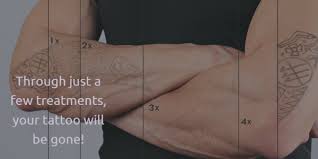 Most especially, these said advancements in tattoo removing services have been bustling in nyc. Picosure Laser Tattoo Removal Manhattan Woodside Nyc