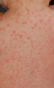Antibiotic Allergy Or Just A Rash Quest For Health Kc