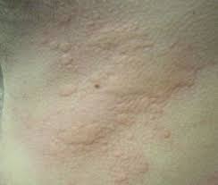 While most allergic reactions involve only one physiological system (the upper respiratory tract or the skin, for example), anaphylaxis is a cascading response involving multiple systems. Anaphylaxis Wikem