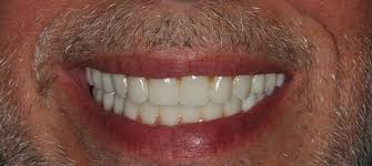 For a comfortable tooth extraction and gentle dentistry, visit the dental specialists at streamline sahara office. Experienced Las Vegas Dentist Lasting Smiles Dental Care Las Vegas