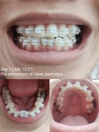An expander is fit by your orthodontist. Cduraermui39km