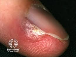 Image result for Glomus tumor