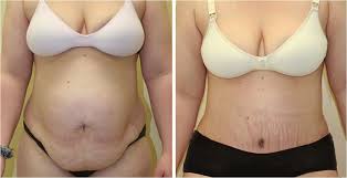 35 Year Old Female After 4 Children Before And After A Tummy Tuck By The Doctors Bhpsg Tummy Tucks Mommy Makeover Surgery Tummy Tuck Surgery