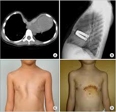 Chek the cool list of 27 celebrities including actors, athletes and musicians. A A 3 Year Old Boy Had Severe Pectus Excavatum With A Pectus Index Of Download Scientific Diagram