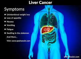 Some common symptoms of liver cancer include: Liver Cancer Treatment Causes Symptoms Signs Prevention