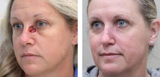Can you spots the signs? Before After Skin Cancer Reconstruction Surgery Photos Dr Michael Mccracken