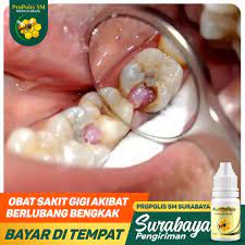 Obat alami gusi bengkak karena gigi berlubang. Obat Herbal Sakit Gigi Terlaris Obat Nyeri Gigi Berlubang Obat Gigi Bolong Bengkak Gusi Solusi Pembengkakan