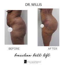 Merz aesthetics earns great place to work certification™ and named one of the healthiest employers of the triangle currently training usually consists of a 1 day course for each treatment offered. Mia Aesthetics On Twitter Bbl By Dr Willis Https T Co Smhju4cbbf Twitter