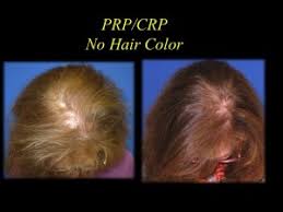Pcos hair loss follows the pattern of hair loss as seen in males. Platelet Rich Plasma Prp And Hair Darkening Hair Loss Cure 2020