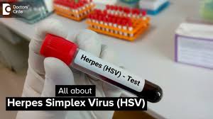 Image result for Herpes Simplex Virus Testing