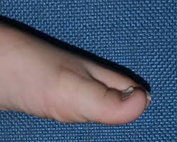 Image result for Koilonychia feet