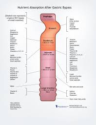 Pin On Bariatric Surgery Weight Loss Surgery