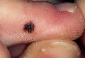 What does testicular cancer feel like? Burning Or Swollen Feet What Foot Pain Symptoms Say About Your Health