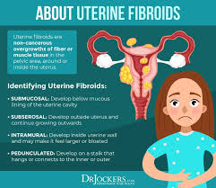 (iii) in rare cases, though, fibroids may contain cancerous cells. Uterine Fibroids Symptoms Causes And Natural Support Strategies Uterine Fibroids Fibroids Treatment Uterine Fibroids Symptoms