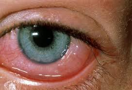 Cats are so susceptible to eye irritants, in fact, that they have a third eyelid to help protect their eyes. Top 13 Ways To Tame Eye Allergies