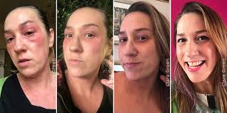 My Top 5 Eczema Tips. Flare ups SUCK! Full Stop.