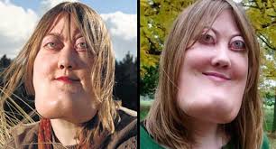 Victoria Wright was diagnosed with cherubism at age 4, a rare genetic  mutation that deforms her facial bones and threatened to leave her blind if  not intervened. The surgery managed to save