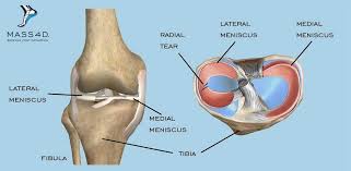 Meniscus Tear Treatment Without Surgery With 3 Exercises Full Guide Meniscus Tear Torn Meniscus Exercises Meniscus Surgery Recovery