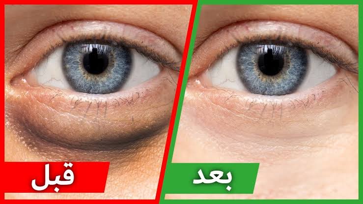 طرق التخلص من الهالات السوداء أسفل العين بشكل نهائي