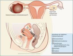 Nun kann ich natürlich nicht behaupten, dass ich nun wisse, was endometriose sei. Endometriose Kinderwunschzentrum Offenbach