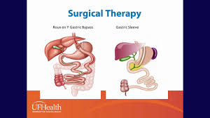 The cost of a gastric sleeve operation here is around half of the price charged in a german clinic and even less than the cost of the same procedure in a british private facility, coming in at around £6,700. Online Seminars Uf Health Bariatric Surgery Center Understanding Obesity Uf Health University Of Florida Health