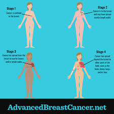 Image result for Breast Cancer Staging