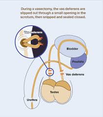 Image result for Vasectomy