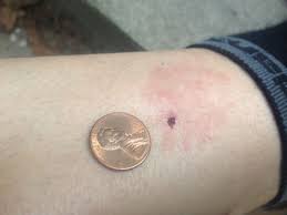 Check spelling or type a new query. How To Know If You Need A Tetanus Shot After A Dog Bite